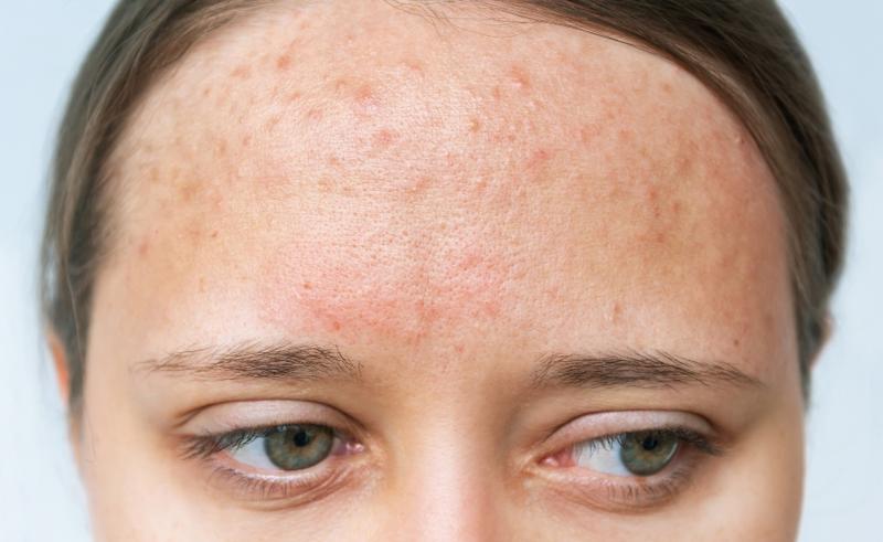 Rutyny dla cery trądzikowej