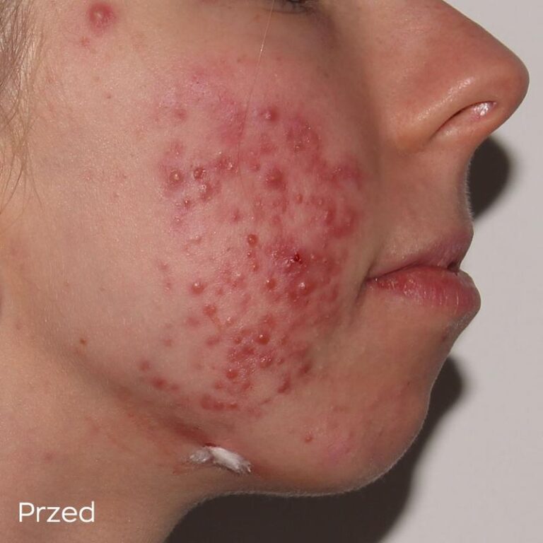 Skuteczne sposoby na złagodzenie objawów trądziku w codziennej pielęgnacji