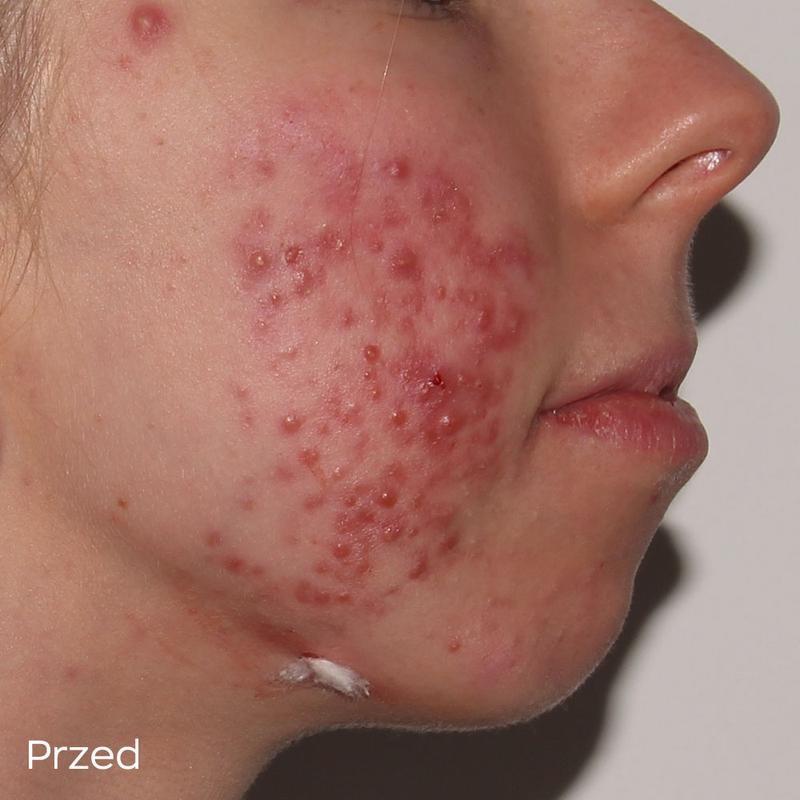 Skuteczne sposoby na złagodzenie objawów trądziku w codziennej pielęgnacji